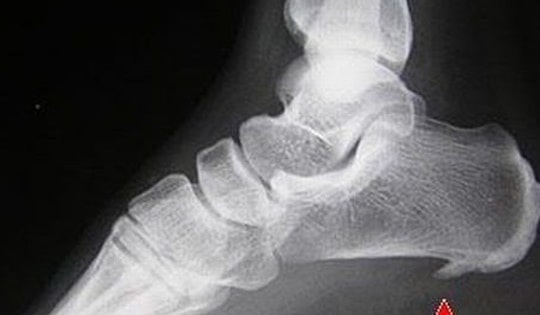 Các phương pháp điều trị gai xương và chăm sóc tại nhà