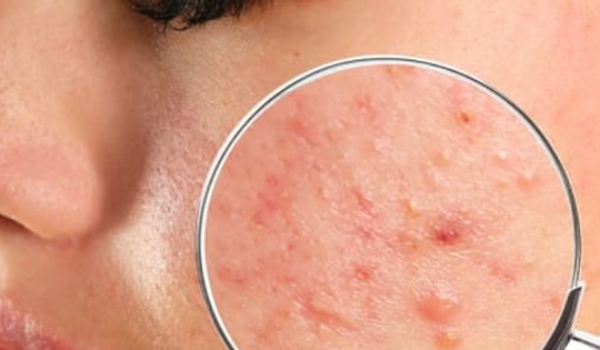 'Thủ phạm' khiến mặt chi chít mụn