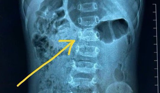 Bé 16 tháng tuổi đã cong vẹo cột sống vì cha mẹ cho tập ngồi từ 7 tháng