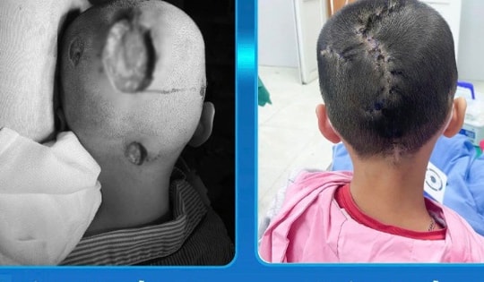 Bé 7 tuổi ở Phú Thọ bị hoại tử, lõm da đầu, bố mẹ thừa nhận mắc sai lầm khi chữa bệnh cho con