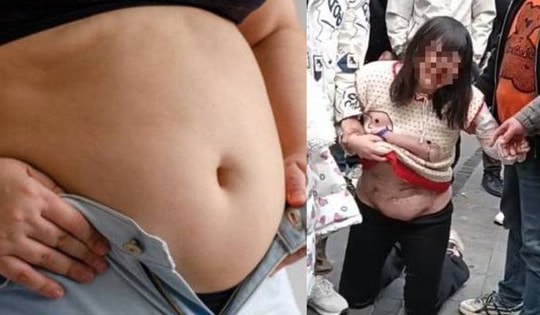 Cô gái trẻ đi hút mỡ bụng bị biến chứng nặng nề, phải quỳ gối xin spa giúp đỡ khiến dân mạng xót xa?