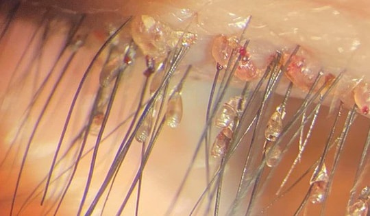 Người phụ nữ 46 tuổi bị rận bám chi chít ở mi mắt, cảnh báo thói quen trong sinh hoạt nhiều người hay gặp phải