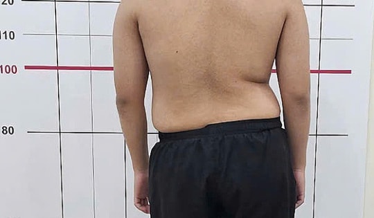 Thanh niên 19 tuổi bất ngờ phát hiện cột sống cong 50 độ, thừa nhận thường xuyên làm việc này trong lúc tập gym