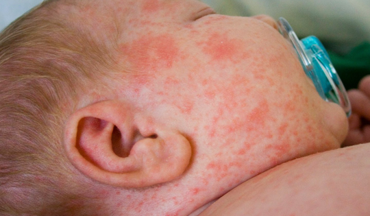 Những lưu ý quan trọng trong mùa dịch sởi, bố mẹ nên biết để bảo vệ con