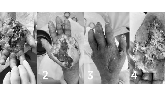 Người phụ nữ 44 tuổi ở Hà Nội nguy cơ mất bàn tay từ vết ngứa nhỏ