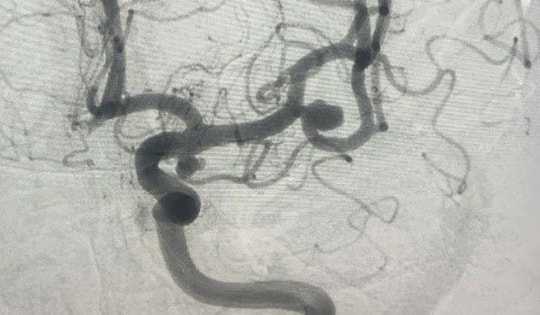 Đau đầu âm ỉ, người đàn ông 58 tuổi ở Hà Nội suýt vỡ mạch máu não vì căn bệnh này