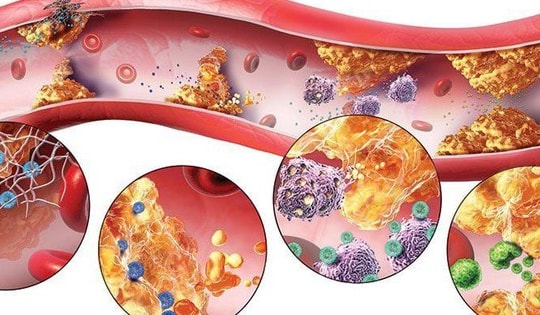 Người đàn ông 43 tuổi ở Phú Thọ bất ngờ phát hiện mỡ máu cao 40 lần, người Việt cần làm điều này để phòng bệnh
