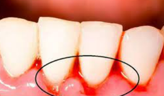 7 dấu hiệu phổ biến nhất khi thiếu vitamin C, cần bổ sung ngay