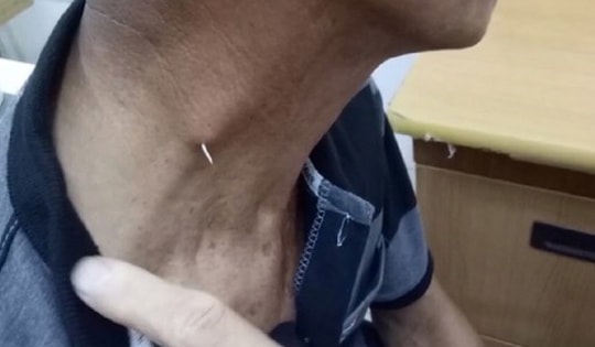 Hóc xương cá, người đàn ông 69 tuổi ở Hải Dương phải nhập viện vì cố làm điều này