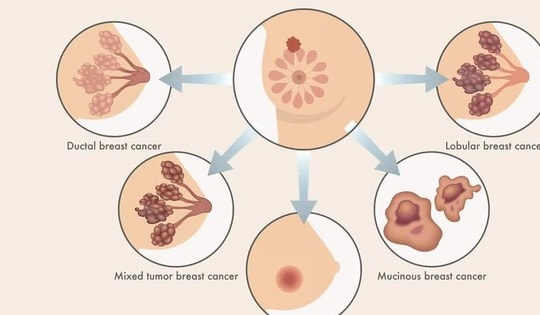 Hy vọng mới cho bệnh nhân ung thư vú giai đoạn đầu