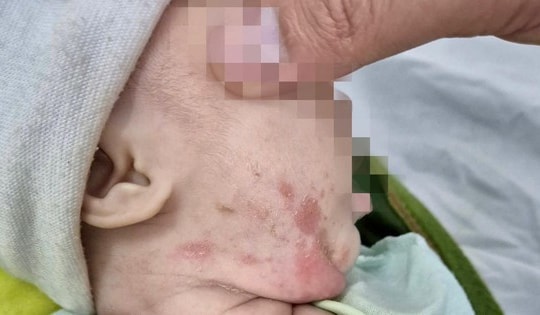 Bé gái 2 tháng tuổi mắc giang mai, bố mẹ bàng hoàng khi biết nguyên nhân