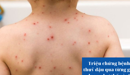 Triệu chứng bệnh thuỷ đậu qua từng giai đoạn như thế nào?