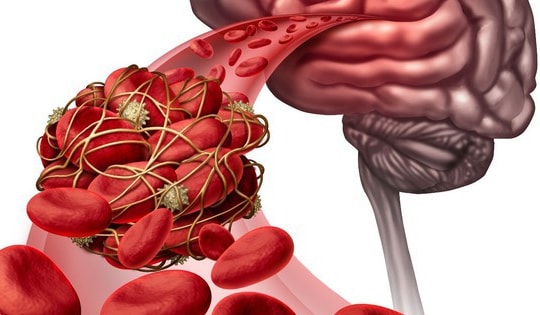 Yếu tố nguy cơ dễ bị đột quỵ mùa lạnh