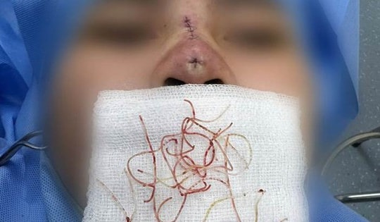 Cô gái 25 tuổi ở Hà Nội thủng mũi, hoại tử sau căng chỉ tại spa