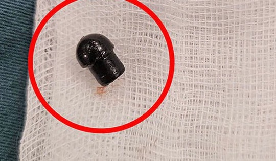 Bé trai 7 tuổi tử vong do hóc đầu bút: Cần làm gì để cứu con trong những tình huống nguy cấp?