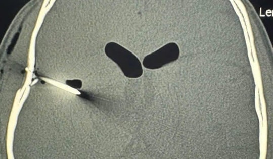 Người đàn ông bị đinh sắt đâm thủng xương sọ khi đang làm việc