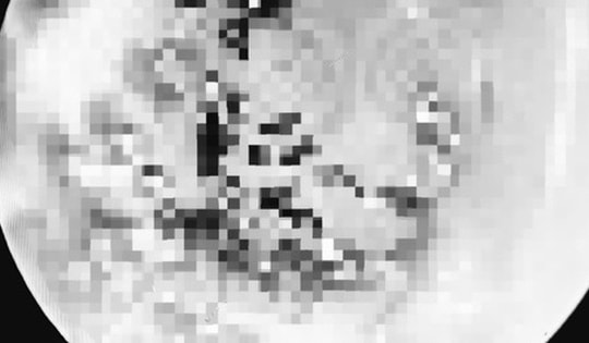 Nội soi gắp ve rận trong tai bệnh nhi 6 tuổi