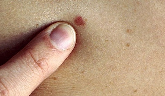 Xuất hiện chấm đen trên mặt, người phụ nữ 50 tuổi ở Bắc Giang sốc khi được chẩn đoán ung thư da