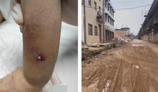 Cậu bé 4 tuổi nguy kịch do chó cắn, chủ vật nuôi tìm cách che giấu