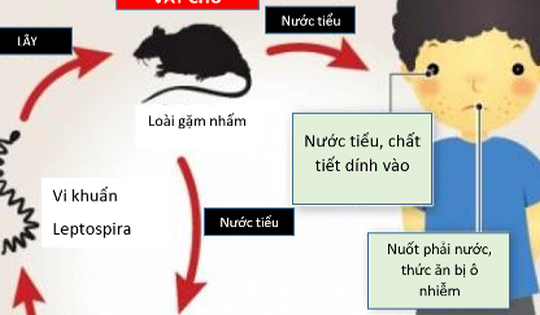 Sốt cao liên tục, 2 trẻ nhập viện trong tình trạng nặng vì nhiễm loại xoắn khuẩn nguy hiểm