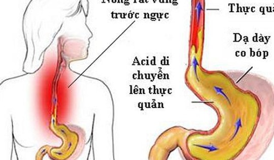 Người phụ nữ 30 tuổi bị loét hoàn toàn thực quản vì một sai lầm nhiều người Việt mắc phải khi uống thuốc