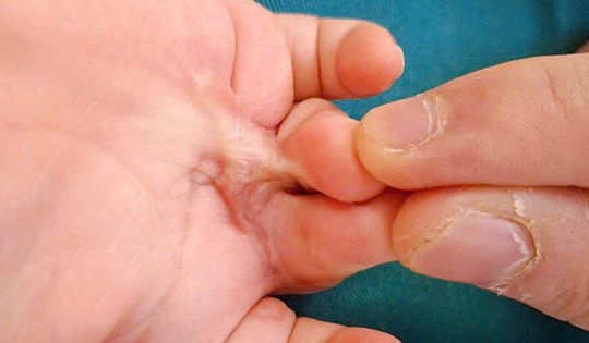 Bé trai 16 tháng tuổi ở Hà Nội bị biến dạng bàn tay vì tai nạn trẻ nhỏ hay gặp trong bếp