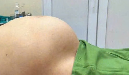 Người phụ nữ có khối u nang buồng trứng to như thai 8 tháng, cảnh báo dấu hiệu bệnh chị em không nên bỏ qua