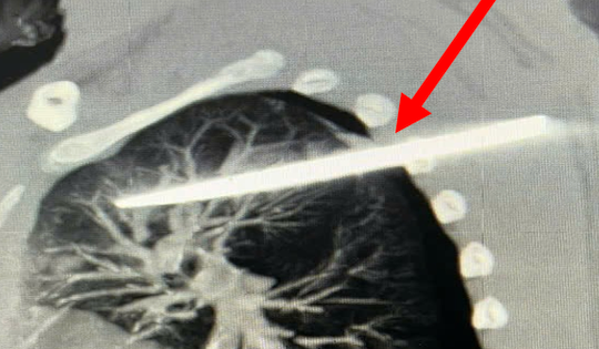 Cứu sống nam thanh niên bị đâm thấu ngực trong đêm