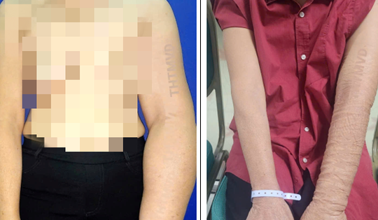 Giải phóng cho người phụ nữ bị phù tay voi sau phẫu thuật ung thư vú