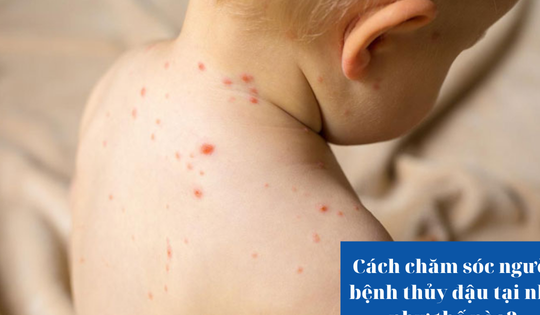 Cách chăm sóc người bệnh thủy đậu tại nhà như thế nào?