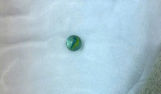 Gắp viên bi trong dạ dày bé trai 5 tuổi, bác sĩ cảnh báo  nguy cơ ảnh hưởng đến tính mạng