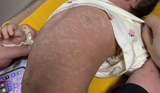 Sốt cao liên tục, ho, chảy mũi, nhiều trẻ nhập viện vì biến chứng nặng, có trẻ phải thở máy