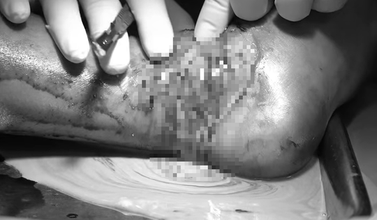 Bé trai 12 tuổi nhiễm trùng nặng do đắp lá chữa bong gân