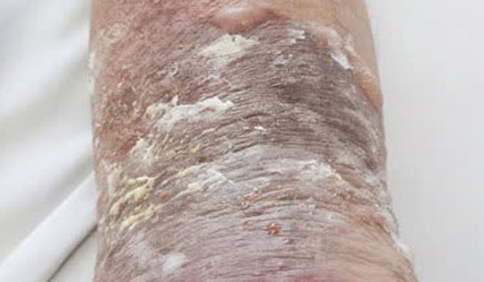 Bị ngã, chấn thương, bong gân nên xoa dầu, dán cao hay chườm lạnh mới đúng?