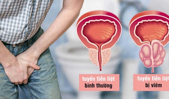 4 bài thuốc dành cho người viêm tuyến tiền liệt mạn tính