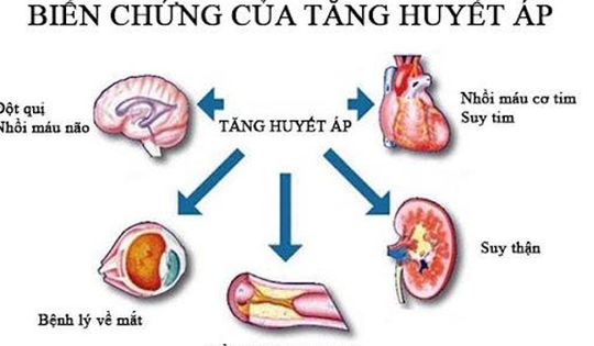 Người phụ nữ 35 tuổi ở Hà Nội bị suy thận, cao huyết áp thừa nhận một sai lầm nhiều người Việt mắc phải