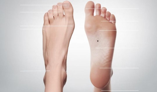 Nốt ruồi ở lòng bàn chân là dấu hiệu của may mắn, tài lộc? Bác sĩ nói có 5 điểm này cẩn thận ung thư