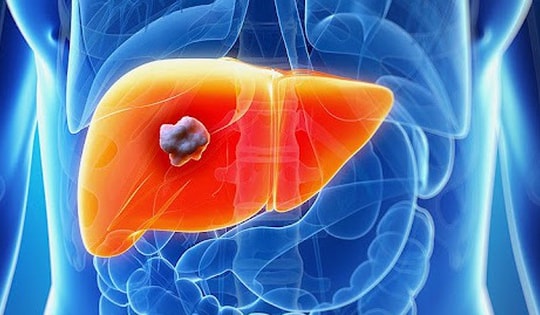 Người đàn ông ở Phú Thọ may mắn phát hiện sớm u gan nhờ làm một việc mà rất nhiều người Việt bỏ qua