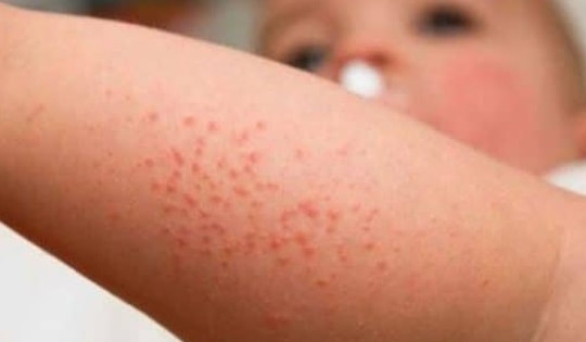 Bệnh sởi có dấu hiệu gia tăng dịp Tết, chăm sóc trẻ mắc bệnh tại nhà như thế nào?