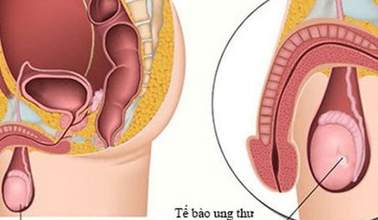 Bé trai 11 tuổi đã mắc ung thư tinh hoàn, chuyên gia cảnh báo dấu hiệu phát hiện sớm bệnh