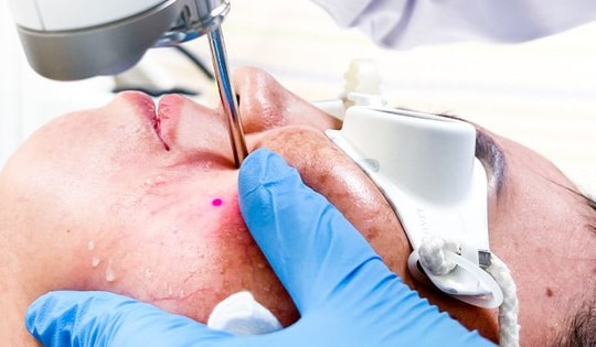 Dùng kem trắng da cấp tốc đón Tết, người phụ nữ 32 tuổi ở Bình Dương nhập viện gấp