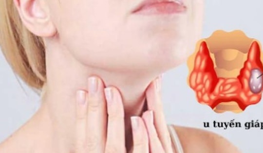 Người phụ nữ 43 tuổi mắc bệnh tuyến giáp được bác sĩ khuyên thường xuyên làm việc này