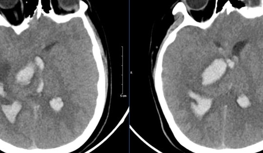 Bệnh nhân 15 tuổi tử vong sau khi bị đau đầu đột ngột, bác sĩ cảnh báo các dấu hiệu cần đến bệnh viện ngay