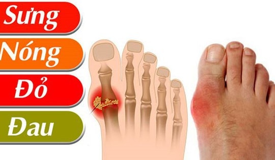 Bất ngờ nam sinh 17 tuổi ở Hà Nội mắc bệnh gút suốt 2 năm mà không hề hay biết