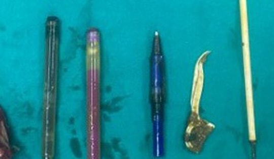 Người đàn ông nuốt bật lửa, bút bi, tăm nhựa vào bụng