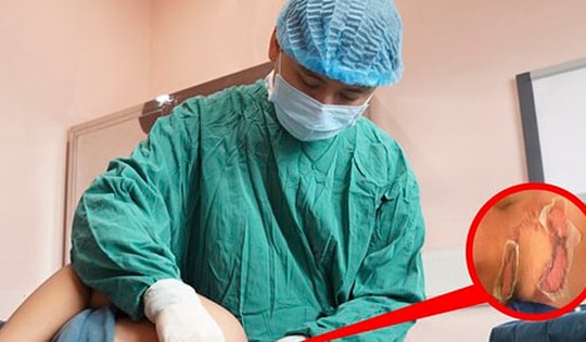 Gia tăng trẻ bị đuối nước, bỏng và ngộ độc trong dịp Tết, chuyên gia chỉ cách sơ cứu đúng để kịp thời cứu con