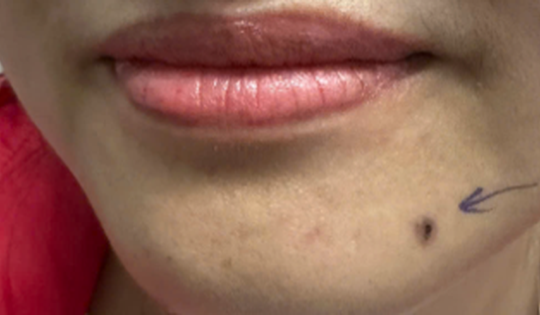 Nhìn tưởng nốt ruồi ở cằm nhưng lại hóa ung thư