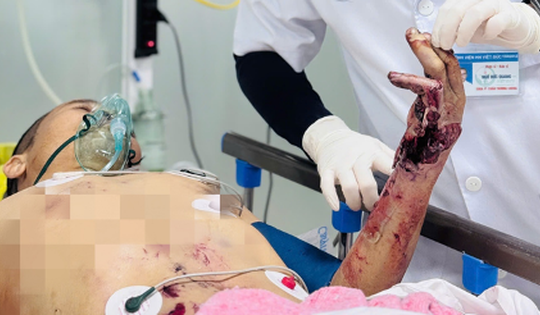 Người đàn ông nhập viện cấp cứu vì bình ga mini phát nổ khi nấu ăn