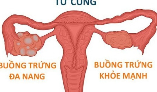 Cô gái 18 tuổi ở Hà Nội bất ngờ phát hiện buồng trứng đa nang từ dấu hiện nhiều phụ nữ Việt bỏ qua
