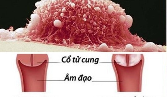 Người phụ nữ 31 tuổi ở Quảng Ninh phát hiện ung thư cổ tử cung từ dấu hiệu nhiều người Việt mắc phải